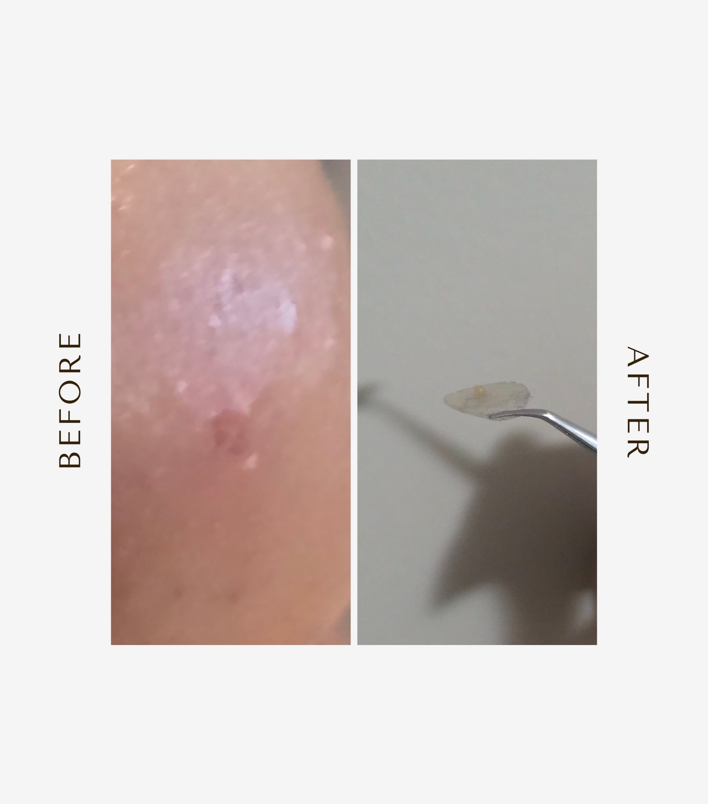 LUNE & BE Spot Patch – 44pcs Hydrocolloid Acne Patches for Blemish Care, Gentle on Sensitive Skin